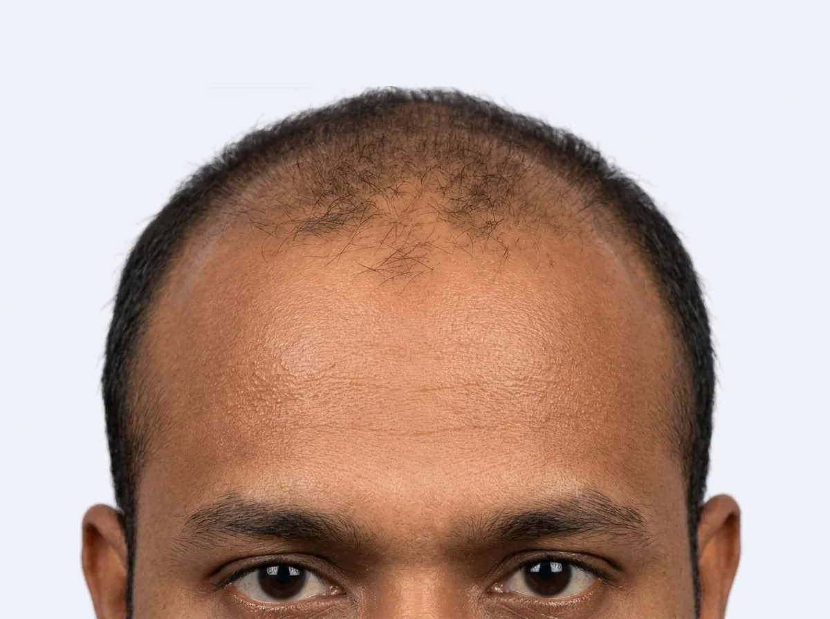 Receded front hairline with visible scalp before treatment